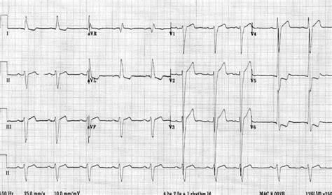 left ventricular hypertrophy life expectancy.